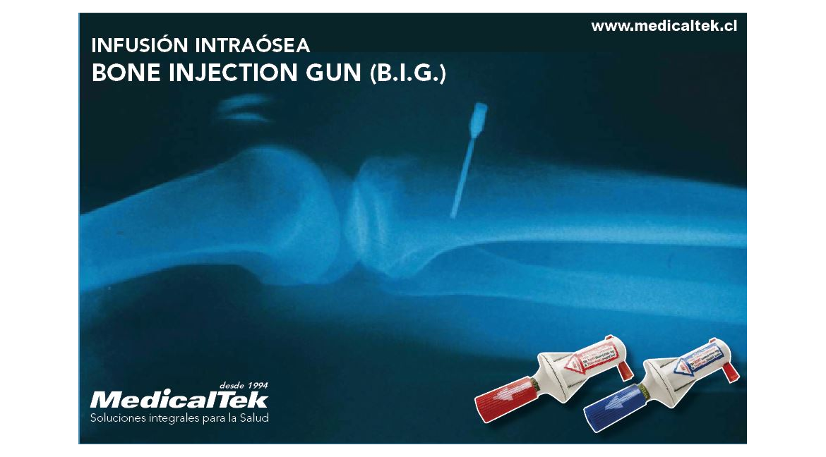 BONE INJECTION GUN (B.I.G.)